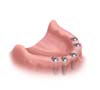 Zahnloser Kiefer mit Implantaten