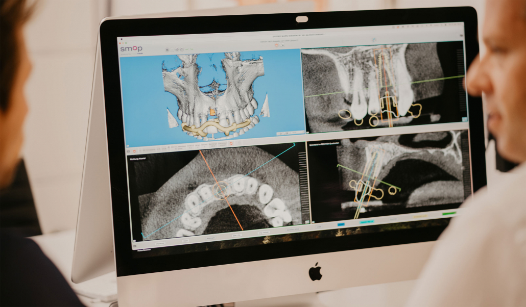 3D-Planung der Implantate am Bildschirm